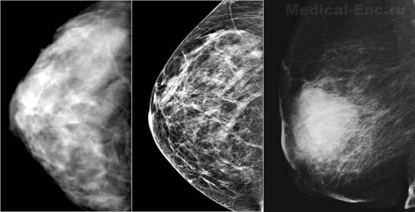 маммография <a href='http://www.вокабула.рф/энциклопедии/медицинская-энциклопедия/рак' class='voclinksee'>рак</a> молочной железы